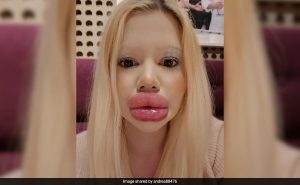 Read more about the article Woman With World’s Biggest Lips Gets More Fillers As Christmas Gift