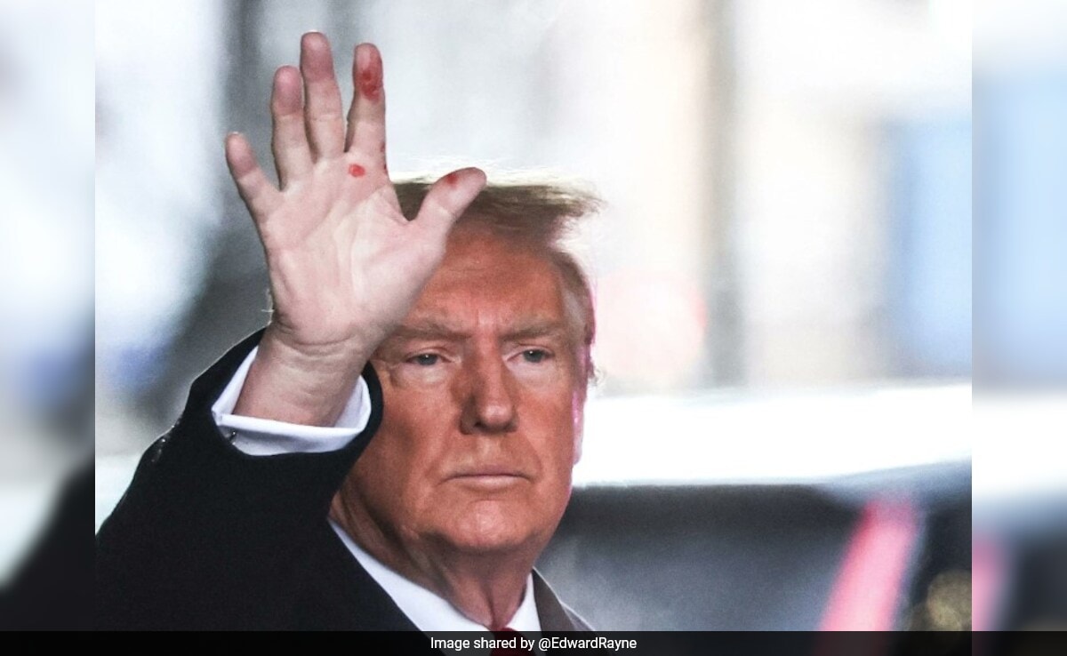 You are currently viewing Donald Trump On Mysterious Red Spots On His Hand