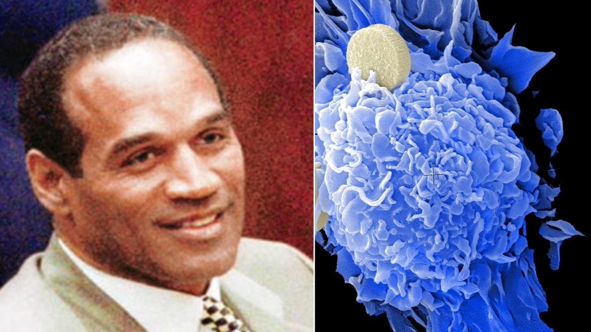 Read more about the article What is prostate cancer that OJ Simpson was battling