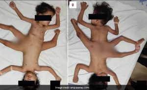 Read more about the article Extremely Rare Conjoined Twins Born In Indonesia Have 4 Arms, 3 Legs
