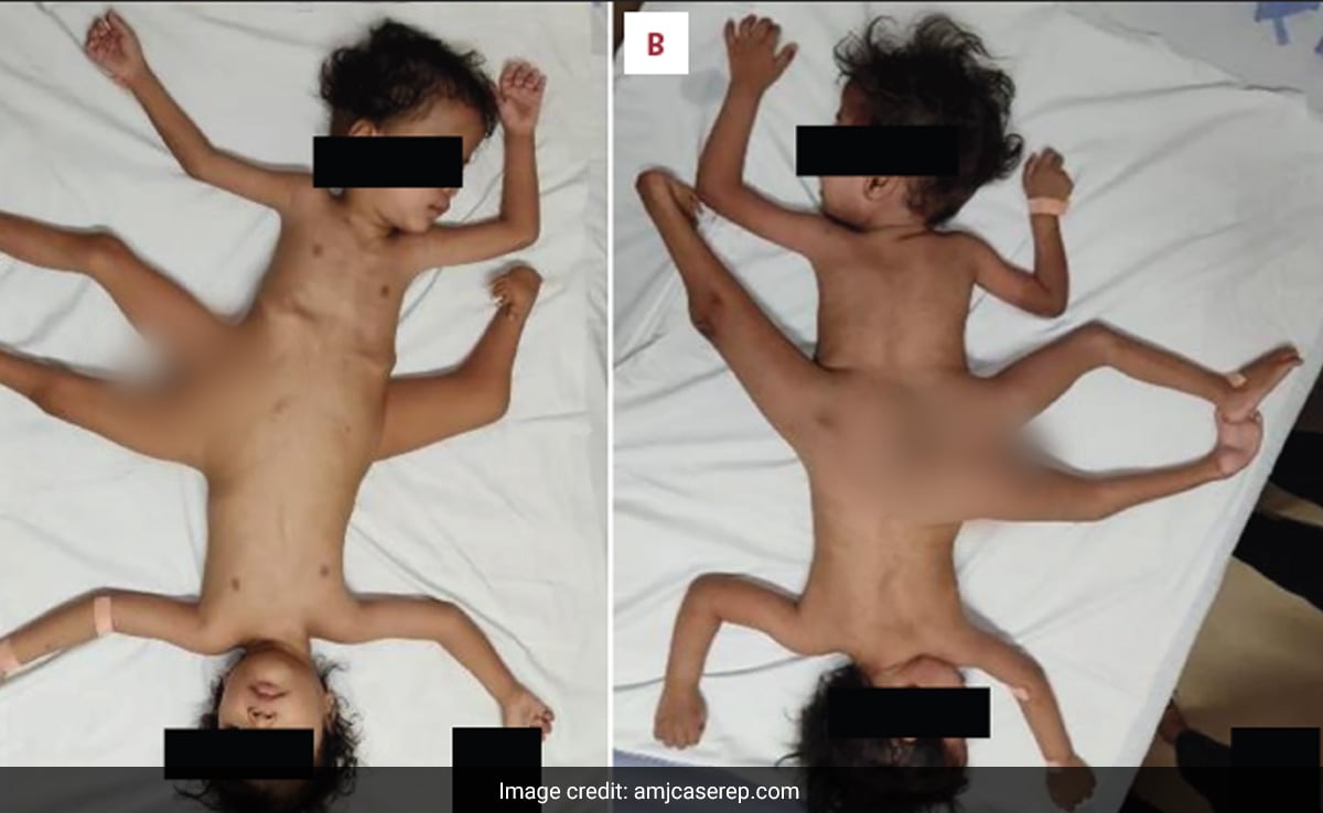 Extremely Rare Conjoined Twins Born In Indonesia Have 4 Arms, 3 Legs